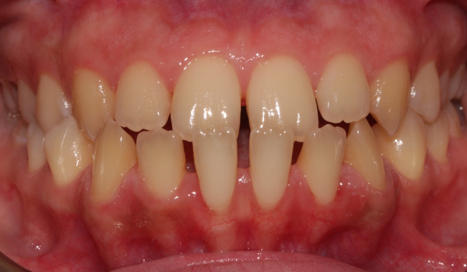 Orthodontic Treatment
