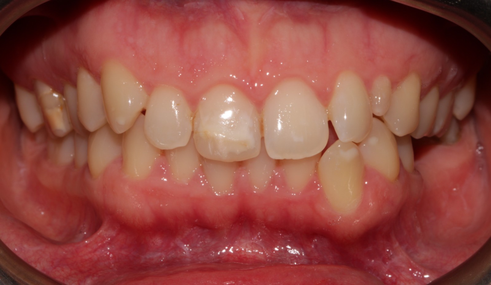 Orthodontic Treatment