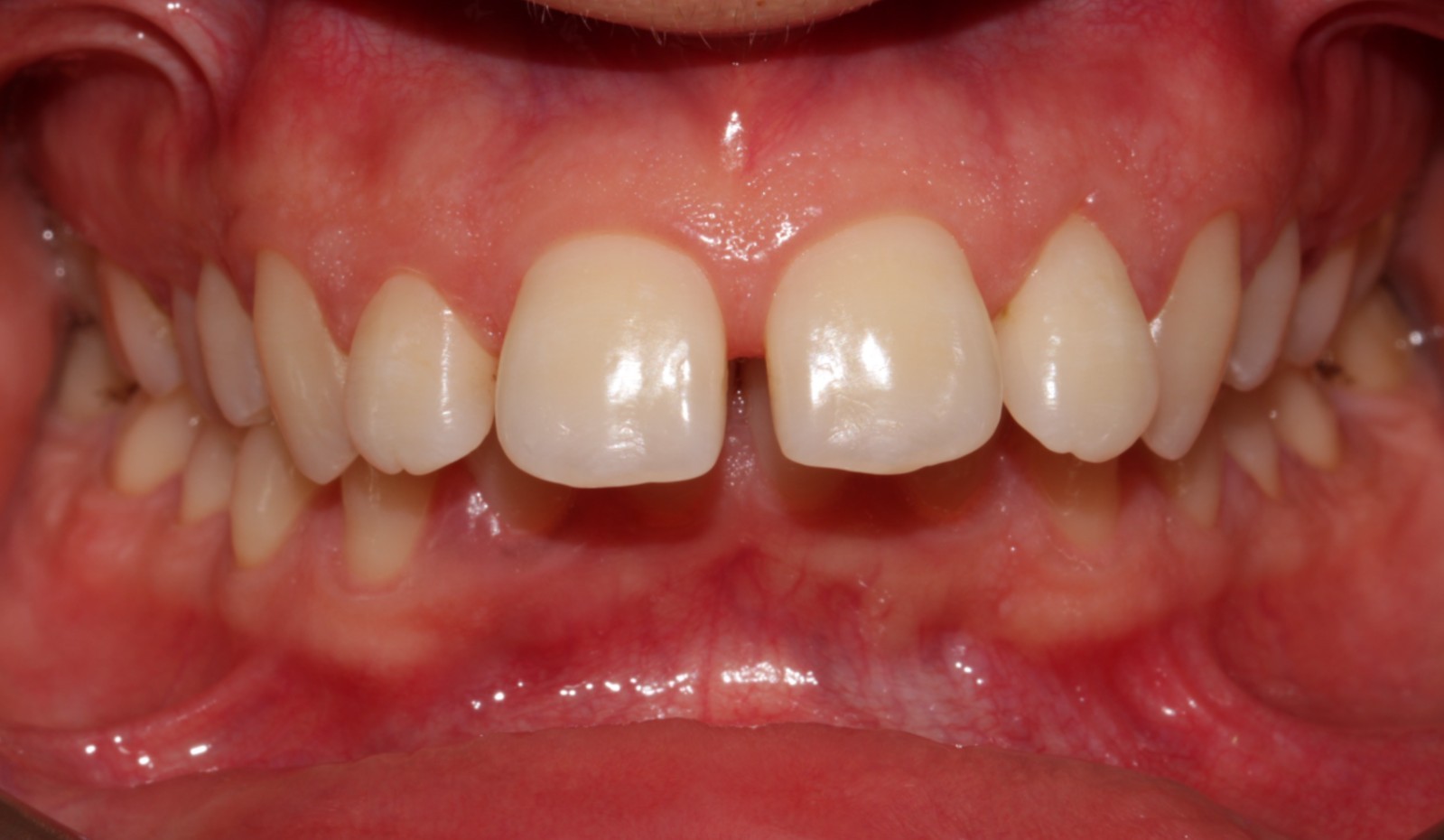 Orthodontic Treatment