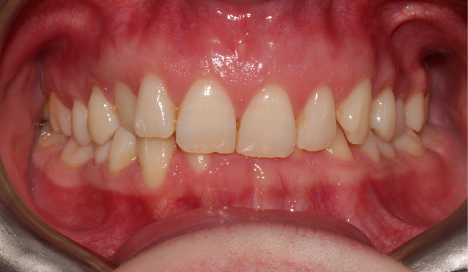 Orthodontic Treatment