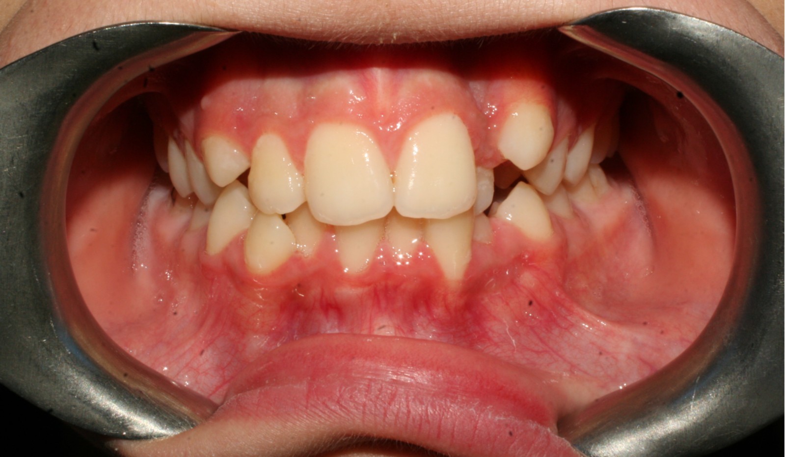 Orthodontic Treatment