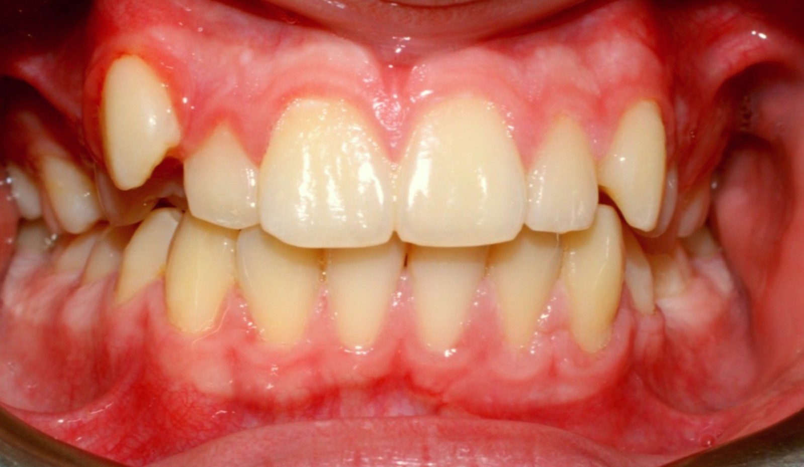 Orthodontic Treatment