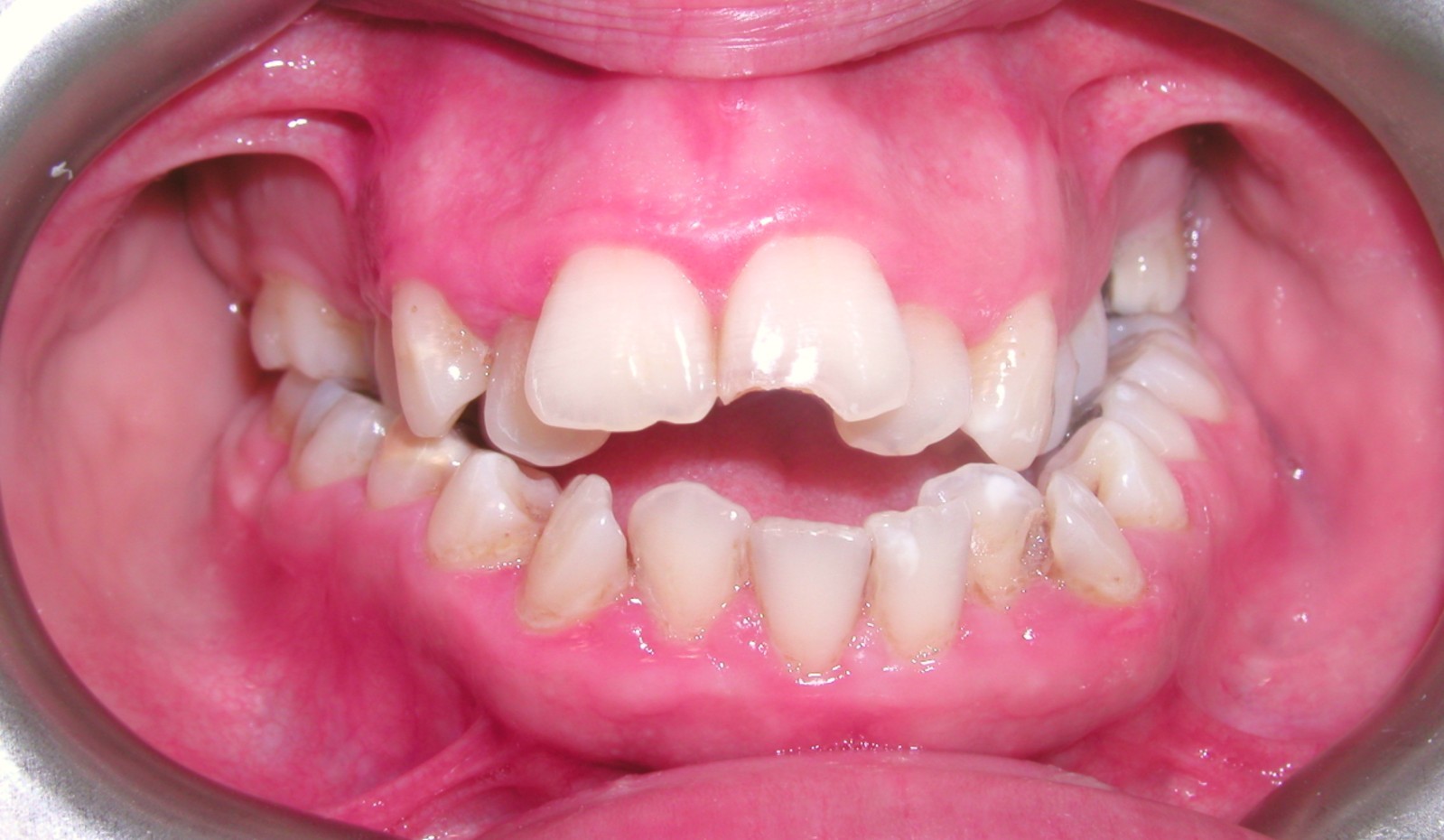 Orthodontic Treatment