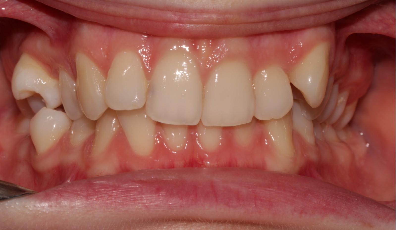 Orthodontic Treatment