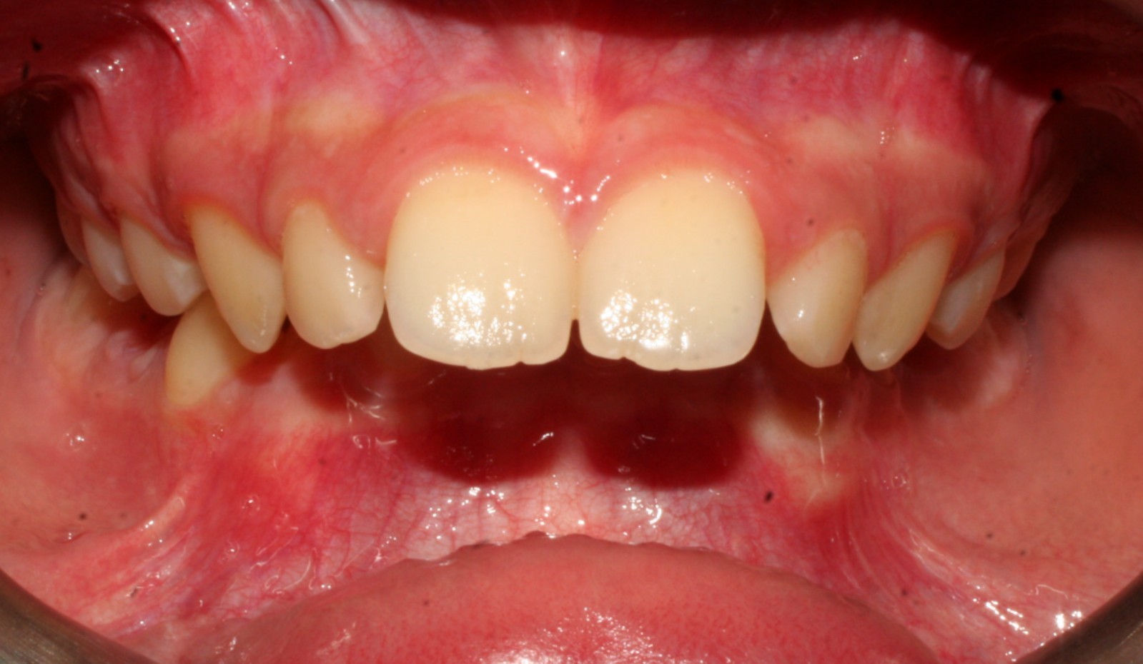 Orthodontic Treatment
