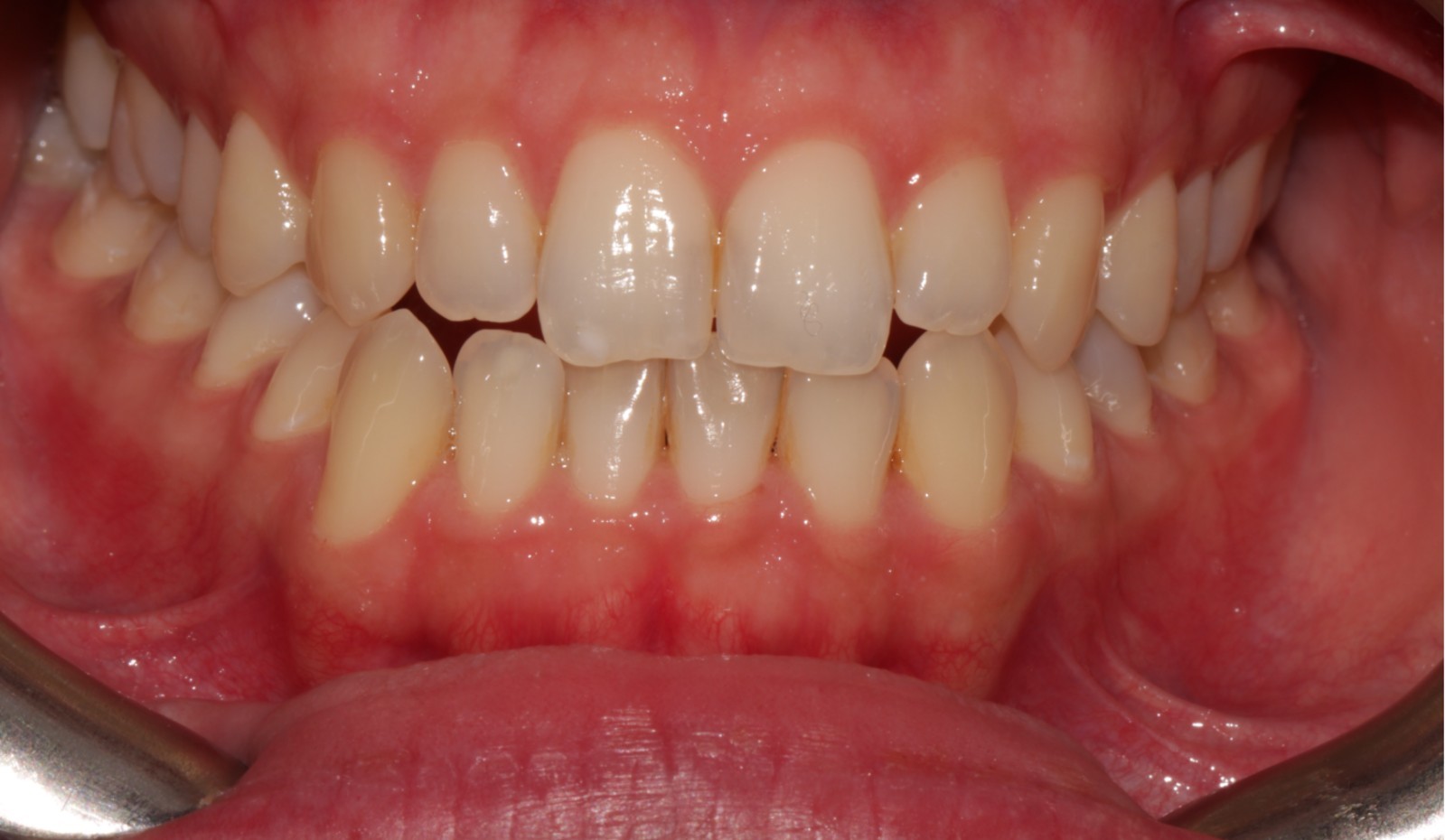 Orthodontic Treatment